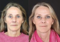 55-64 year old woman treated with Deep Plane Facelift, Facelift, Neck Lift, Brow Lift
