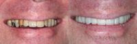 40 year old man Treated with Porcelain Veneers