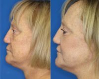 55-64 year old woman treated with Lip Surgery