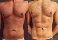 25-34 year old man treated with Liposculpture