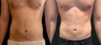 Man treated with Vaser Liposuction