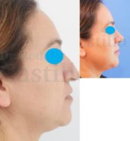 45-54 year old woman treated with Rhinoplasty