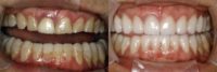 Full Mouth Smilemaker after treating TMJ
