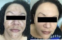 Woman treated with Melasma Treatment For 2 Months Only (Only Sunscreen On After Photo)