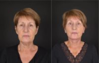 65-74 year old woman treated with Facelift