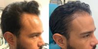 Hair Transplant