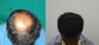 25-34 year old man treated with Hair Transplant