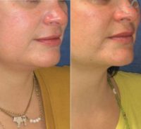 35-44 year old woman treated with Chin Liposuction