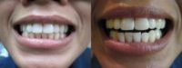 Zoom Teeth Whitening