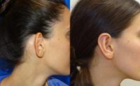 18-24 year old woman treated with Ear Surgery
