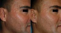 25-34 year old man treated with Microneedling for acne scars