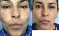 45-54 year old woman treated with Dermal Fillers