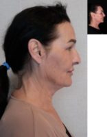 45-54 year old woman treated with Facelift, Neck Lift