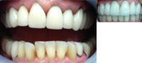 Full Mouth Replacement of Old Crowns