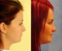 25-34 year old woman treated with Open Tertiary (3rd) Revision Rhinoplasty