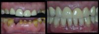 55-64 year old man treated with Dental Crown