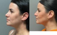 35-44 year old woman treated with Chin Liposuction