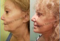 Woman treated with Facelift