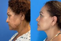 55-64 year old woman treated with Facelift, Facial Fat Transfer