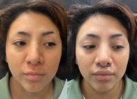 18-24 year old woman treated with Lip Lift