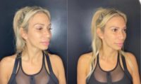 35-44 year old woman treated with Dermal Fillers