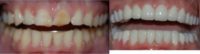 45-54 year old woman treated with Smile Makeover