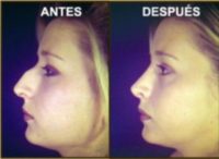 18-24 year old woman treated with Rhinoplasty