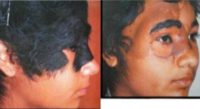 18-24 year old woman treated with Facial Reconstructive Surgery