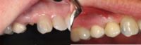 45-54 year old woman treated with Mini Dental Implants