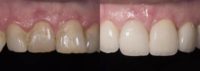 Porcelain veneers for old and discolored teeth