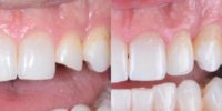 Dental Bonding to Repair a Broken Tooth