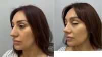 35-44 year old woman treated with Rhinoplasty, Chin Liposuction, FaceTite