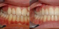 17 or under year old woman treated with Invisalign
