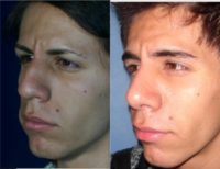 18-24 year old man treated with Rhinoplasty