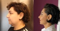 25-34 year old woman treated with Chin Liposuction, Rhinoplasty, Nonsurgical Neck Lift, Eyelid Surgery