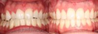 25-34 year old man treated with Clear Braces