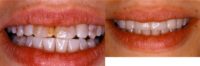 35-44 year old woman treated with Porcelain Veneers