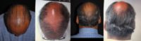 45-54 year old man treated with Hair Loss Treatment