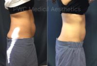 35-44 year old woman treated with SculpSure