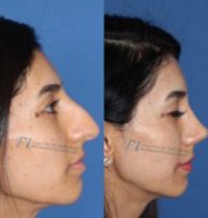 25-34 year old woman treated with Rhinoplasty