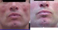 45-54 year old man treated with Injectable Fillers