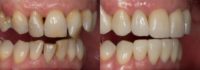 55-64 year old woman treated with Porcelain Veneers