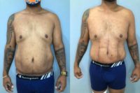 35-44 year old man treated with Tummy Tuck