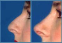 Woman treated with Rhinoplasty