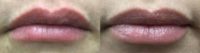Lip Filler | Total Of 1.5 CC