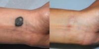 18-24 year old woman treated with Scar Removal