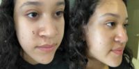 18-24 year old woman treated with Rhinoplasty