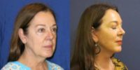 45-54 year old woman treated with SMAS Facelift