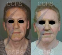 57 year old man treated with SMAS Facelift