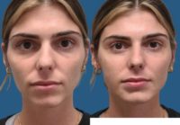 18-24 year old woman treated with Sculptra Aesthetic